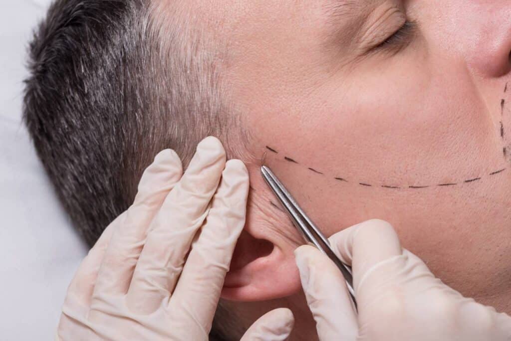 microinjerto en barba en clínica bk