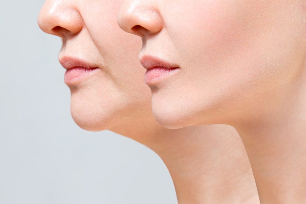 rejuvenecimeiento facial clinica bk 02
