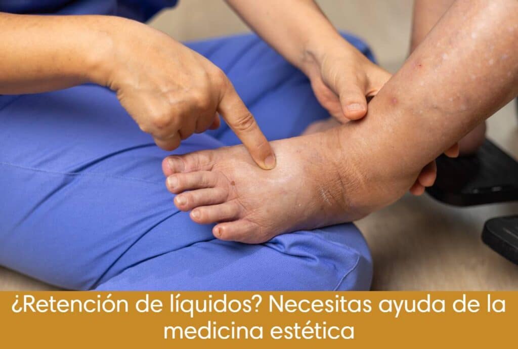 ¿Retención de líquidos? Necesitas ayuda de la medicina estética
