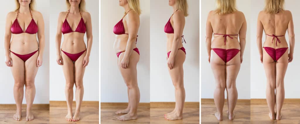 Resultados en una paciente con tratamientos de liposucción sin cirugía