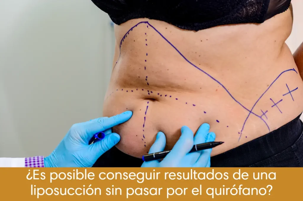 ¿Es posible conseguir resultados de una liposucción sin pasar por el quirófano?