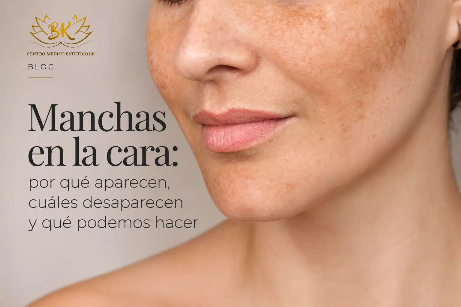 Primer plano de una mujer con manchas faciales y pigmentación irregular, imagen del artículo sobre las causas y tratamientos de las manchas en la cara de Clínica BK